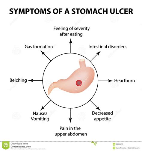 Symptoms of a Stomach Ulcer. Infographics Stock Vector - Illustration ...