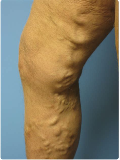 Varicose Vein Miller Vein