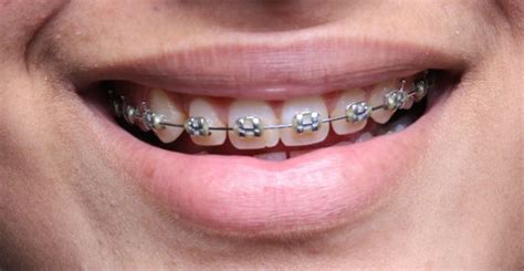 Clear Braces Vs Mini Diamond Braces Brodie Bowman Dmd Traditional Braces Ceramic Braces