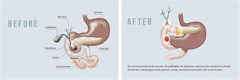 A Complex Lifesaving Surgery For Pancreatic Cancer The Statesir