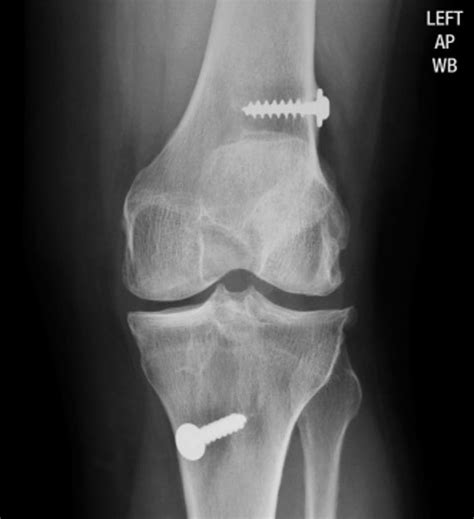 Anterior Cruciate Ligament Acl Repair And Reconstruction Surgery