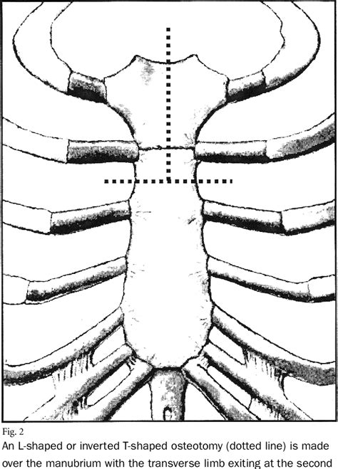 Figure 2 From Anterior Approach To The Cervicothoracic Junction By