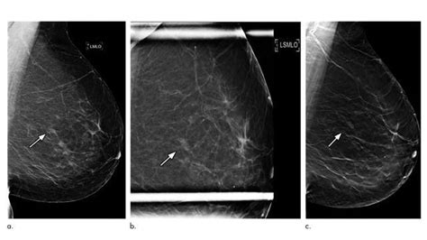 3d Mammography Significantly Reduces Breast Biopsy Rates Technology