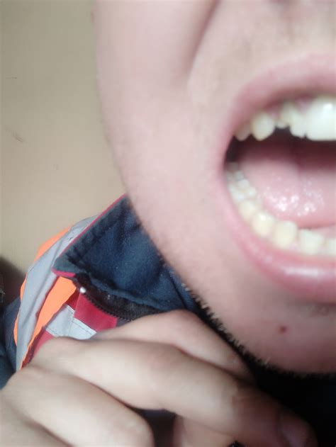 Как воссстановить коронку из пластмассы? | Пикабу