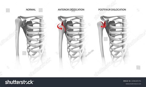 Shoulder Dislocation Options Vector Illustration Stock Vector (Royalty Free) 2246185751 ...