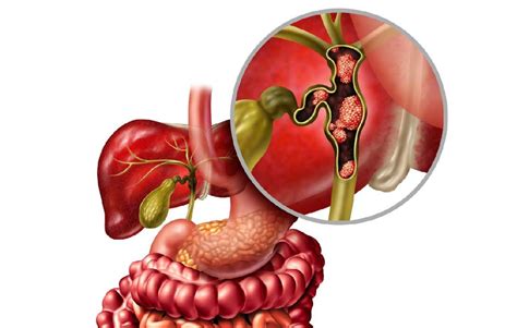 Bile Duct Cancer Treatment in Mumbai | SSOHospital