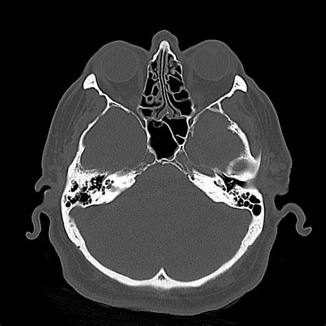 File Subdural Hematoma Uncal Herniation And Duret Brainstem Hemorrhage