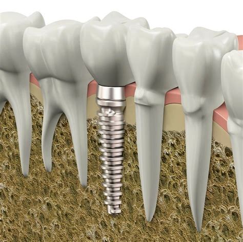 implant surface matters  dental implants hiossen