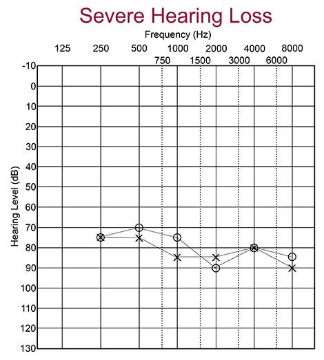 Hearing Loss Chart For Hearing Levels Minga
