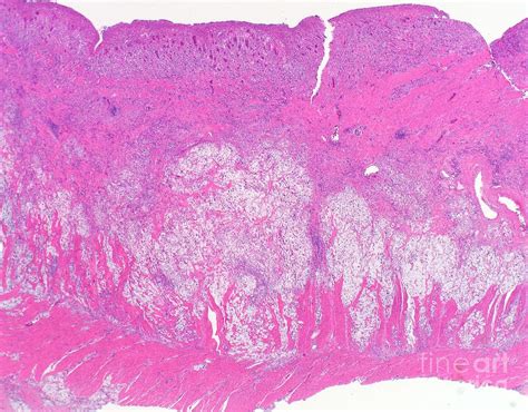 Signet Ring Cell Carcinoma Of The Colon Photograph By Webpathologyscience Photo Library