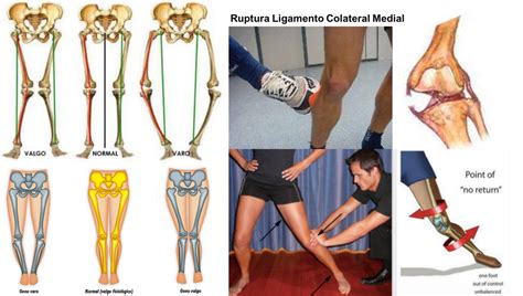 La Rodilla Parte Ii Lesiones Ligamentarias