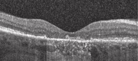 Degenera O Macular Relacionada Idade Dmri Blog Da Oftalmomaster