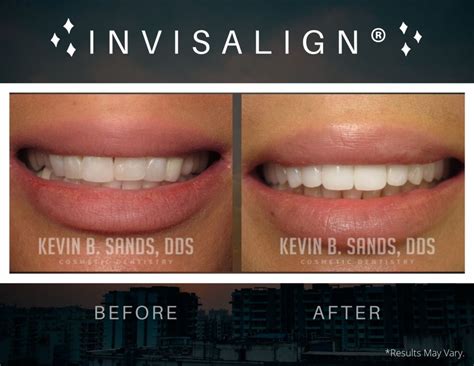 Teeth Before And After Invisalign