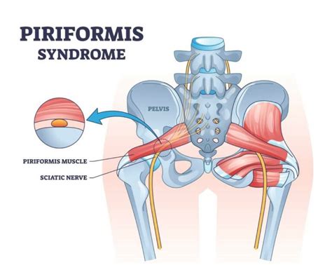 What Is Piriformis Syndrome Turkey Istanbul Medical