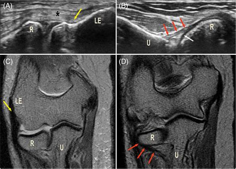 Ulnar Collateral Ligament Elbow Mri