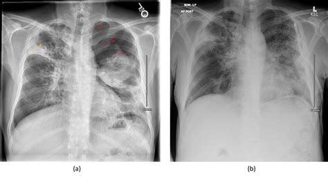 A Two Months After Initial Tb Diagnosis Cxr On Admission Showing New