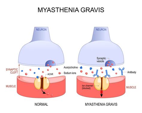 Myasthenia Gravis Mg Gejala Jenis Penyebab Dan Cara Mengatasinya