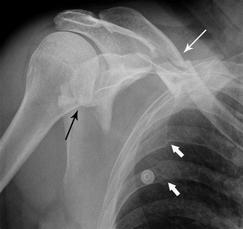 Comminuted Scapular Fracture