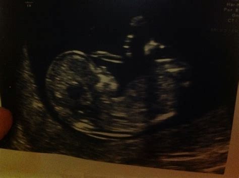 Anyone Fancy Guessing The Sex Scan Tomorrow Mumsnet