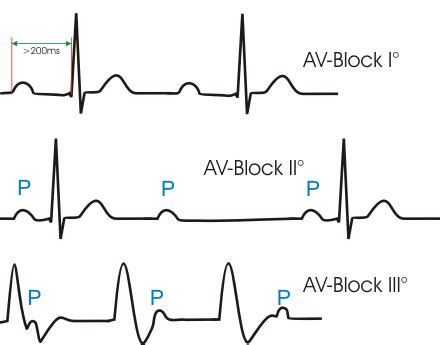 av block herzdoktor