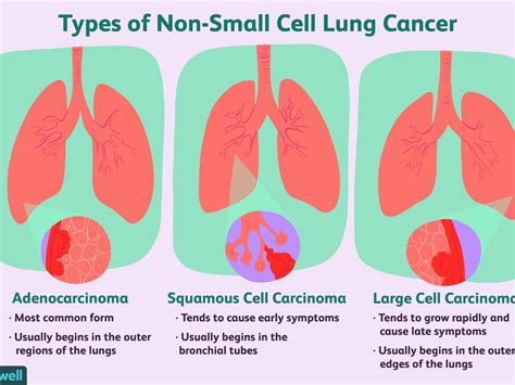 En Segundo Lugar Partido Colaborar Con Lung Cancer Medical Term Conciso