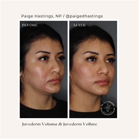 Juvederm 1 Syringe Before And After At Stephen Jamerson Blog