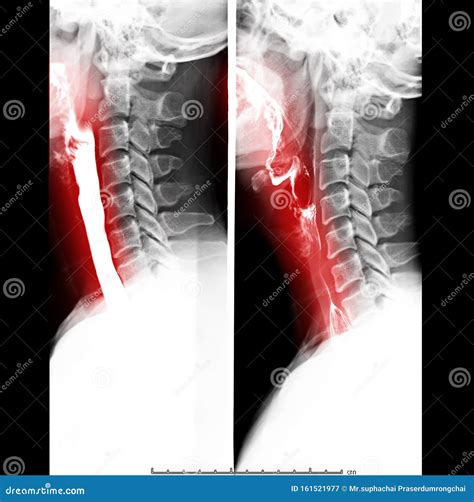 Esophagram Or Barium Swallow Image Showing Esophageal Stent Placement