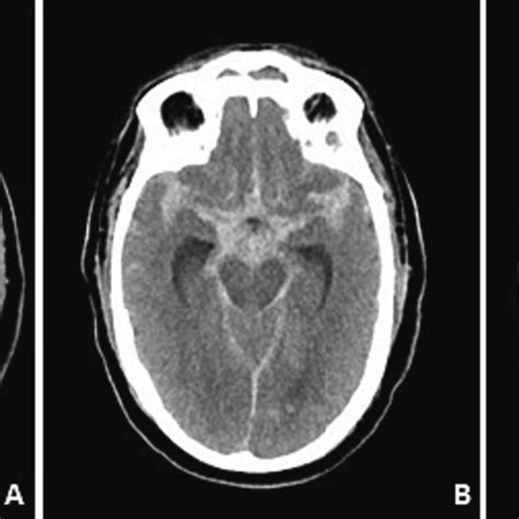 plain ct scan   head showing bilateral subarachnoid hemorrhage