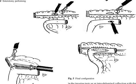 Figure 2 From Intracorporeal Ileocolic Anastomosis In Patients With