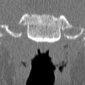 CT of TMJ arthritis (coronal section) | Download Scientific Diagram