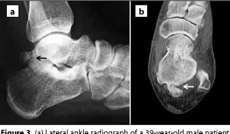 Figure 1 from The Accessory Ossicles of the Foot and Ankle; a Diagnostic Pitfall in Emergency ...