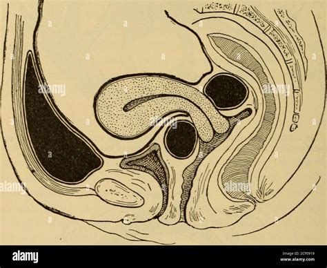 Parametritis