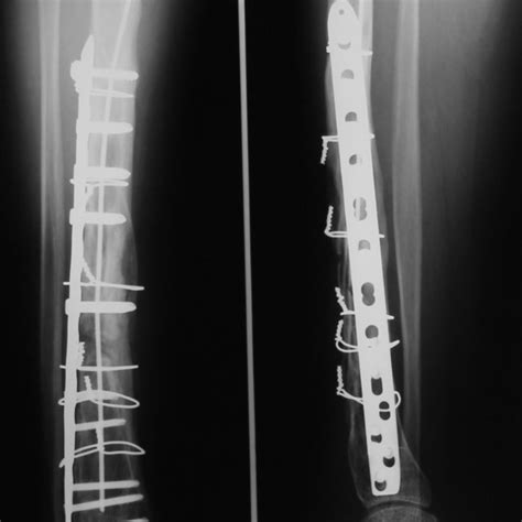 Case Number 2 Postoperative Radiogram At 1 Year And 6 Months Follow Up