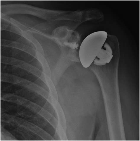 Stemless Anatomic Total Shoulder Arthroplasty Surgical Technique And Review Of The Literature