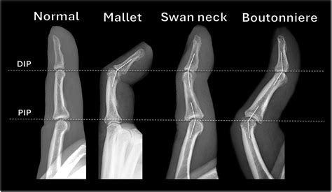 imaging  injury   extensor mechanism   fingers