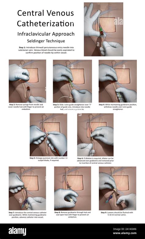 Cateteres Venosos Totalmente Implant Veis Hist Rico Off