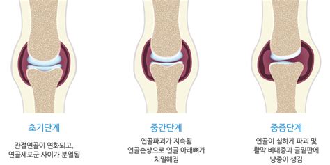 퇴행성관절염 목동동신한방병원