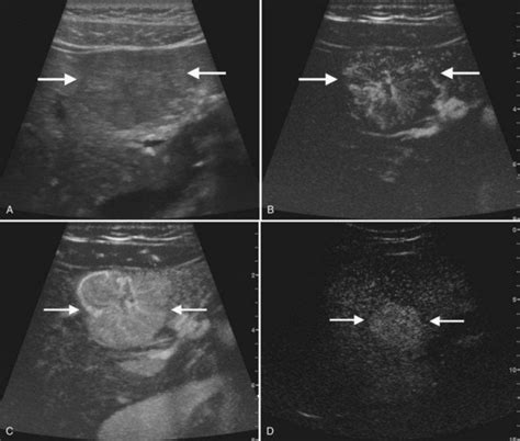 Ultrasound Of The Liver Biliary Tract And Pancreas Clinical Gate