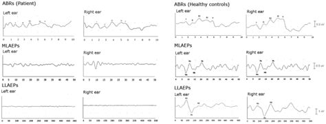 Auditory Brainstem Responses Abrs Top Middle Latency Auditory