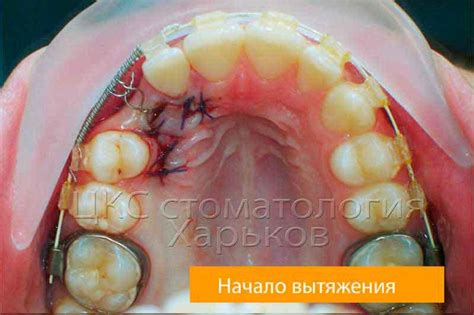 Лингвальные кнопки. Стоматология в Харькове