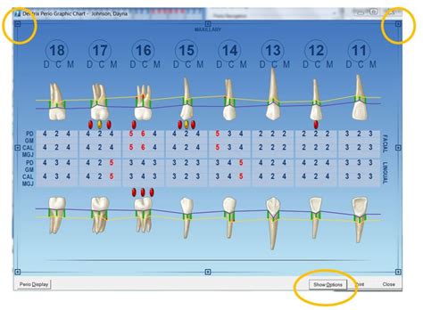 Ada Guidelines For Perio Charting A Visual Reference Of Charts Chart