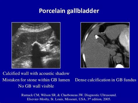 Ultrasound Of The Gallbladder