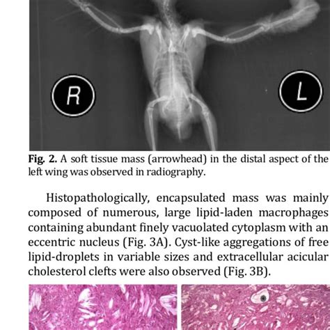 A The Mass With Numerous Large Lipid Laden Macrophages Containing