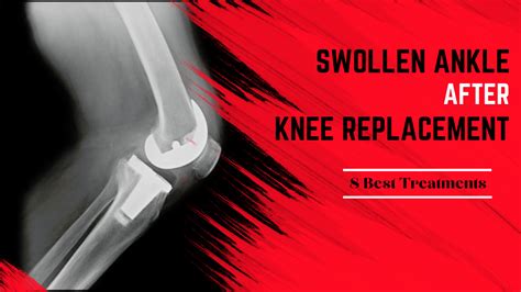 Swollen Ankle After Knee Replacement 8 Best Treatments