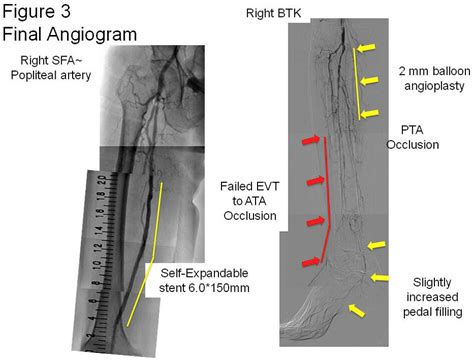 Tctap C 222 Successful Limb Salvage Case Of Critical Limb Ischemia Patient With Systemic