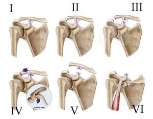 Luxación Acromio Clavicular Dr Gustavo Armando Tafoya Arreguín