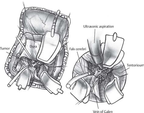 Ventriculoatrial Shunt | Neupsy Key