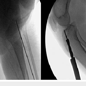 Serial Of Fluoroscopic Images Showing The Surgical Technique Using The