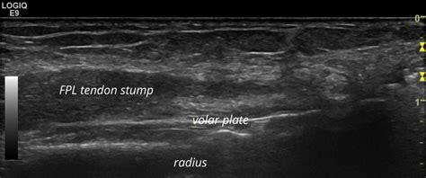 Tear FPL-tendon volar plate after radius fracture | SonoTool®