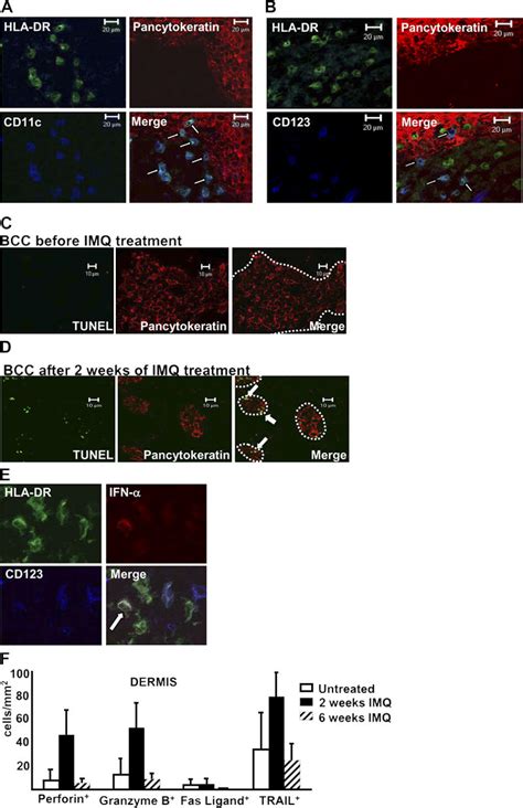 Induction of tumor cell apoptosis is accompanied by peritumoral ...